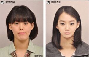 高丽民族黑科技！令人震惊的韩国整容案例盘点