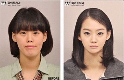 高丽民族黑科技！令人震惊的韩国整容案例盘点